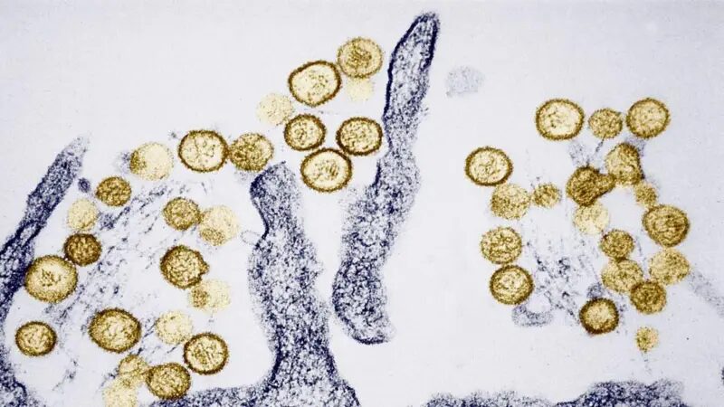 Ministerio de Salud confirma hantavirus en Anzoátegui tras decesos y descarta nexo con casos en Barinas