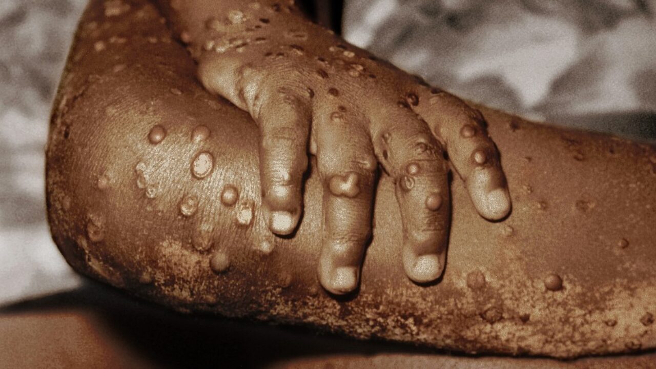 Confirmaron 584 muertes por la viruela del mono en el Congo y la OMS espera más casos en Europa
