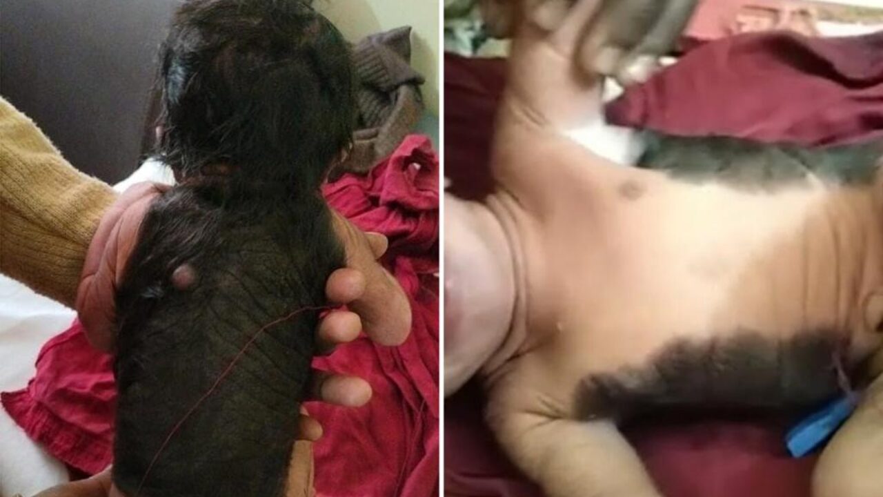 Un bebé en la India nació con extraña condición  que hace que tenga 60% cuerpo cubierto de pelo