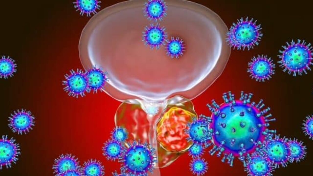 Un fármaco contra un tipo de cáncer de próstata mostró mejoras significativas ante la enfermedad