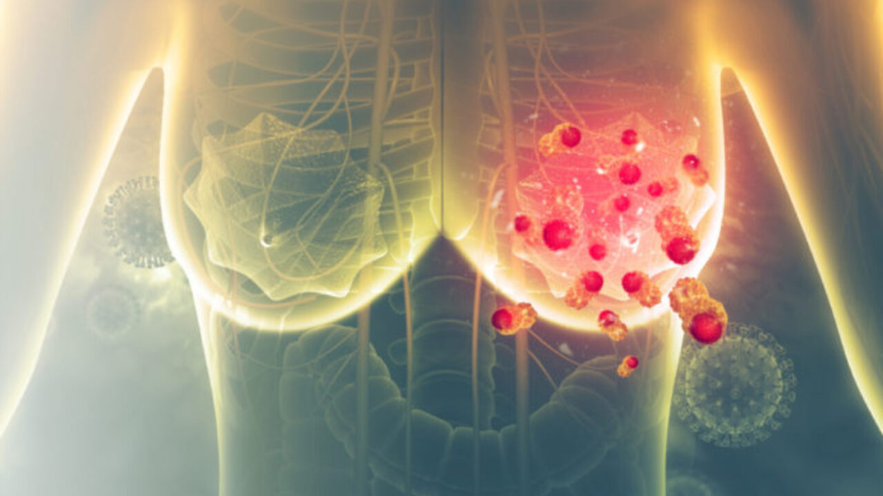 Aplican método basado en inteligencia artificial para predecir  cáncer de mama antes de su desarrollo