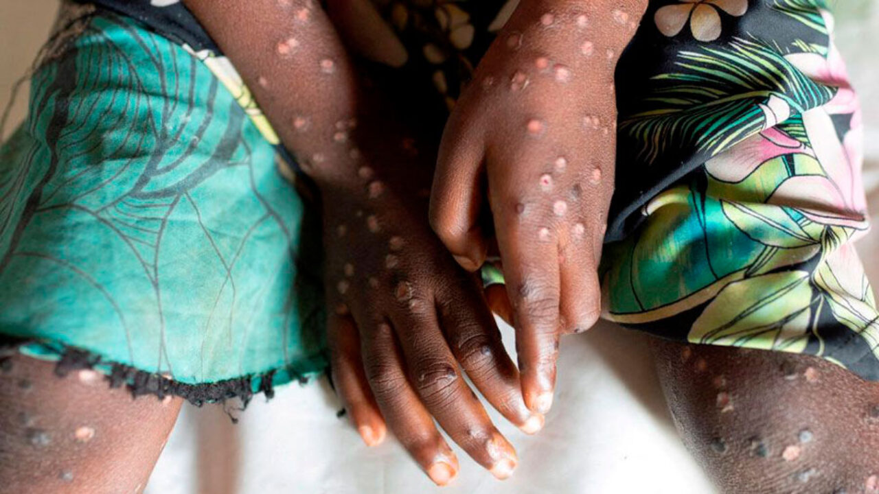 ¿Qué es el mpox o virus de la viruela del mono, cómo se contagia y cómo se puede prevenir?